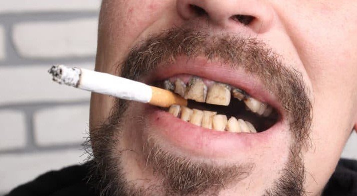 How to remove Tobacco stains from Teeth instantly